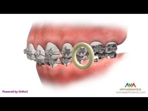Orthodontic Rubber Bands - If Not Worn As Instructed Orthodontic Rubber Bands - If Not Worn As Instructed