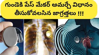 Pacemaker in Telugu|| గుండె పేస్ మేకర్ అమర్చే విధానం||తీసుకోవల్సిన జాగ్రత్తలు.