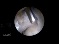 arthroscopic capsular closure of the hip featuring the capsuleclose scorpion™ suture passer