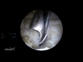 arthroscopic capsular closure of the hip featuring the capsuleclose scorpion™ suture passer