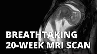 Breathtaking 20-week MRI scan