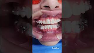 Ortodoncia con Brackets Damon - Dental Home