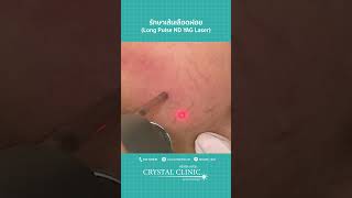 รักษาเส้นเลือดฝอย | Long Pulse Nd YAG Laser | โดย คริสตัลคลินิก