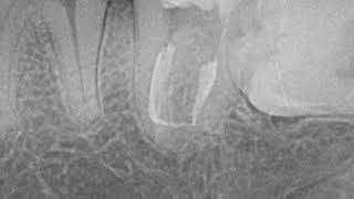 Endodontic treatment of severely curved canal