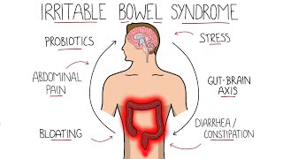 Irritable Bowel Syndrome (IBS) - Including Symptoms, Criteria & Treatment!