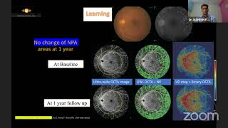 AIOC2021 - GP70 - Topic - Dr. Divyansh k Mishra -Newer ways to image the retinal vasculature