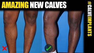 Calf Implants for Men in NYC, Chicago and Los Angeles