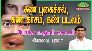 கண் புகைச்சல் | கண் காசம் | கண் படலம் போக்க உதவும் கசாயம் | கோவை பாலா