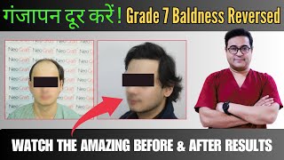 Hair Transplant Miracle: Before \u0026 After Results of Grade 7 Baldness |