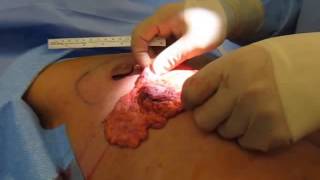 Gynecomastia gland on chest after excision **Graphic**