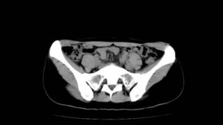 私のレントゲン写真　割れ目が！！！ X‐ray  違法なものではりません