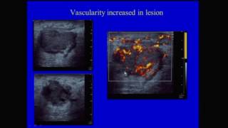 Bi-Rads for Ultrasound