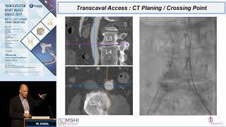 M. Kasel | The rapid emergence of transcaval TAVR. Techniques and clinical outcomes.