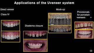 Uveneer on two centrals. Tips and tricks from the inventor