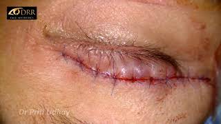 Asian Eyelid Surgery | Asian Blepharoplasty | Double eyelid surgery - Procedure Explained