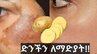 የፊት ማድያትን ለማስወገድ 100% ውጤታማ የሆነ / Remove Face Pigmentation , Dark Spots , Brown Spots 100% effective