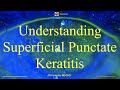 Understanding Superficial Punctate Keratitis.