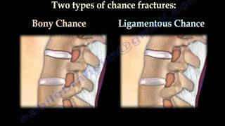 Chance Fractures of the Spine - Everything You Need To Know - Dr. Nabil Ebraheim