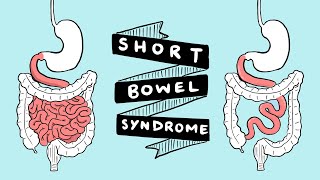Short Bowel Syndrome Symptoms and Complications | What is SBS? | GI Society