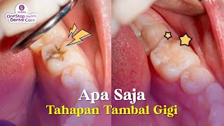 TAHAPAN DAN PROSES TAMBAL GIGI, APA SAJA SIH ?