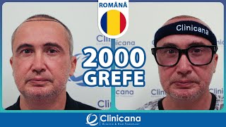 Experiența despre implantului de păr a pacientului dl Cristian din România