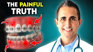 Do Braces Really Hurt? The Truth is..