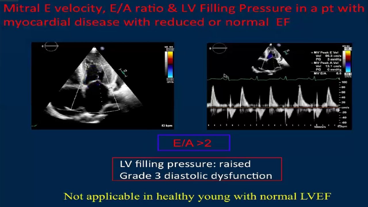 Lv Systolic Diastolic Function Echo Assessment By Dr Debika