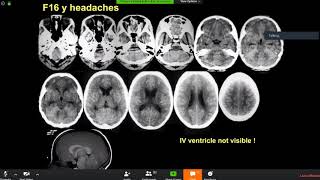 Pediatric Neuroradiology Lectures: acute pathology and pitfalls PART 2 by Felice D'Arco