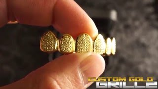 18k Canary Diamond Teeth by Custom Gold Grillz