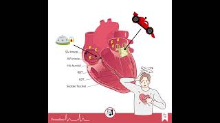 ECG-casus: een snel, breed en onregelmatig ritme