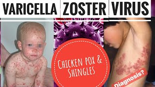 Varicella-zoster virus (VZV)- Chicken pox |Shingles |Congenital varicella syndrome