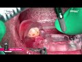 Online Surgery: OneGuide surgery with SS implant