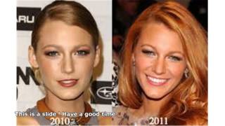 Blake Lively Nose Job Interview