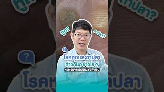 โรคหูดและตาปลาแตกต่างกันอย่างไร ? #หูด #wart #verrugas #ตาปลา #humanpapillomavirus #โรคผิวหนัง