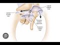 Pathways of Cholesteatoma Spread