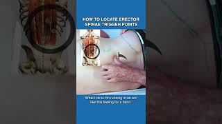 How to Locate Erector Spinae Trigger Points