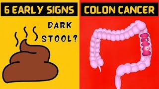 6 Early Signs of Colon Cancer You Shouldn't Ignore!!!