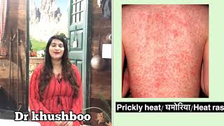 घमोरियो के लक्षण, कारण,इलाज । Treatment of Prickly heat rash | Heat rash Prevention tips