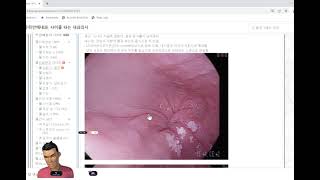 식도이완불능증 (achalasia) 내시경 소견 - 사이클타는 내과의사, 우리안애내과