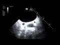 Bladder Diverticulum, US  JETem 2020