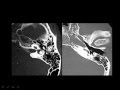 Radiology - Imaging of the Petrous Bone - Skull