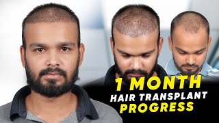 Hair Transplant in Ayodhya | Best Results \u0026 Cost of Hair Transplant in Ayodhya