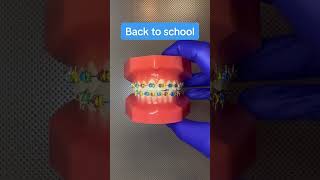 Best braces colors for back to school 🏫 #drwindhorst #choiceorthodontics #braces #bracescolors