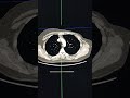 ct assessment looking at internal thoracic arteries