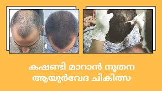 കഷണ്ടി മാറാൻ നൂതന ആയുർവേദ ചികിത്സ | Hair Transplant Ayurveda Treatment