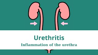 #urethritis : Causes, Symptoms, and Effective Treatment Options