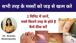 मस्सों को जड़ से खत्म करें, warts treatment, मस्सों का होम्योपैथिक इलाज़, #drrenukahomeopathy