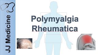 Polymyalgia Rheumatica | Signs \u0026 Symptoms, Diagnosis and Treatment