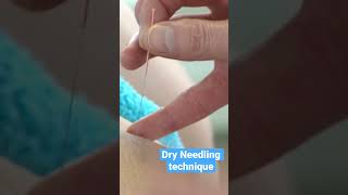 Dry Needling Peppering Technique