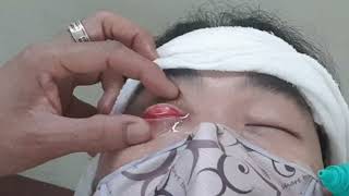 Clean the eyelids (full video)まぶたを綺麗にするทำความสะอาดเปลือกตา